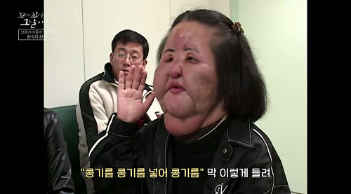 '선풍기 아줌마' 한혜경, 2년 9개월간 15차례 수술…이물질만 4kg