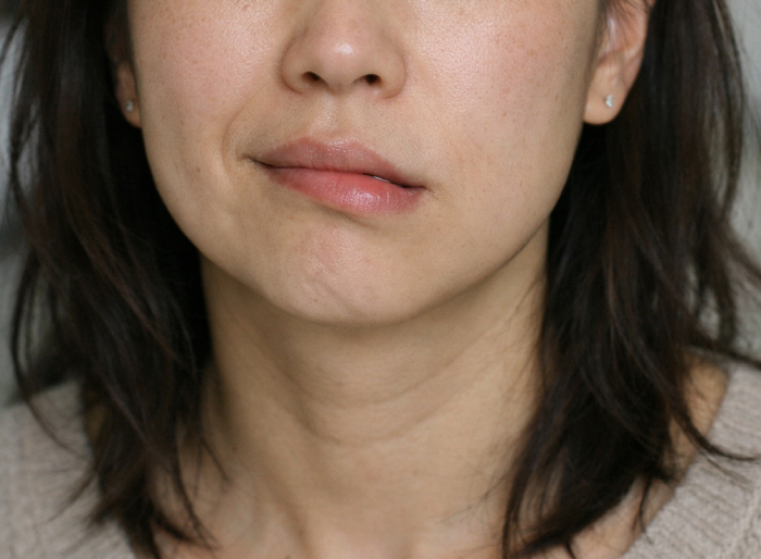 '비뚤어진' 얼굴 어쩌나?…안면신경마비 통합의료 '회복률' 83.3%