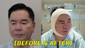 68세 심형래, 얼굴 싹 갈아엎었는데..