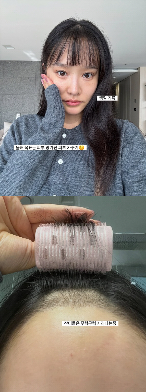 '37세' 헤이지니, 둘째 낳고 '얼굴 기미 범벅'..리프팅·모발이식으로…