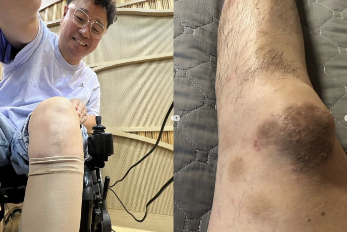 김송, '하반신마비' ♥강원래 수발만 25년 "발톱 빠져도 통증 못 느껴"