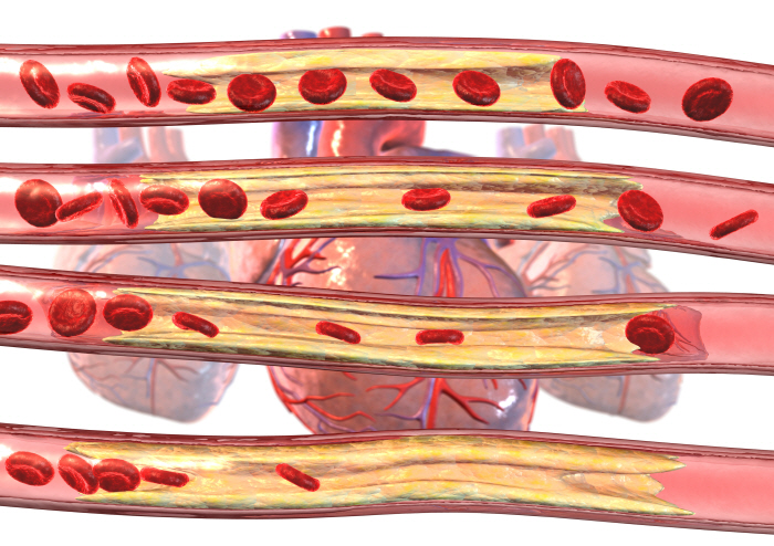 가슴 통증 없는데 '협심증'?…당뇨병·고령 환자 특히 주의