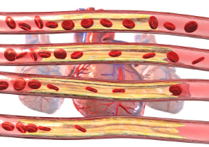 가슴 통증 없는데 '협심증'?…당뇨병·고령 환자 특히 주의