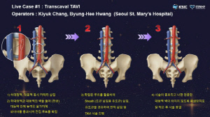 서울성모병원, 국내 첫 경대정맥 대동맥 판막 치환술 성공