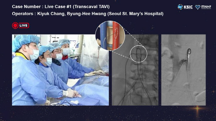 서울성모병원, 국내 첫 경대정맥 대동맥 판막 치환술 성공