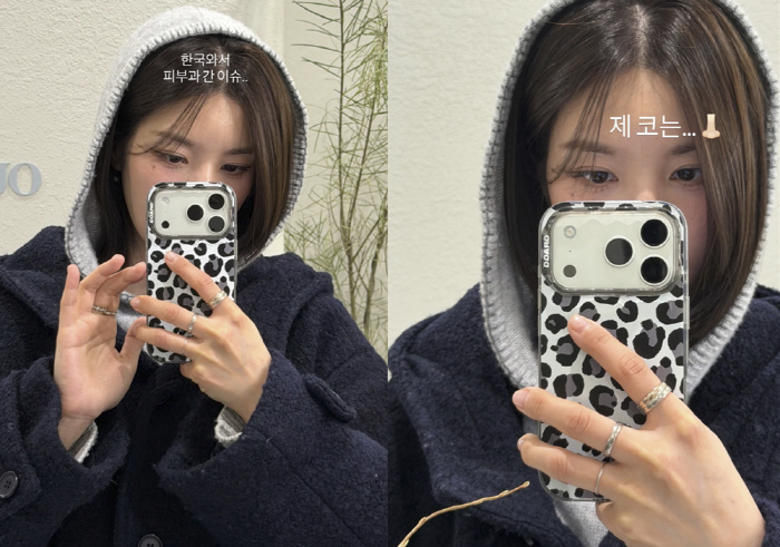 권은비, 코·입술 '2도 화상' 충격 비주얼...결국 병원행 "붉어지고 …