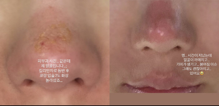 권은비, 코·입술 '2도 화상' 충격 비주얼...결국 병원행 "붉어지고 …