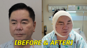 '67세' 심형래, 안면거상 후 달라진 얼굴 