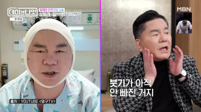 심형래, 얼굴 붕대 칭칭 '안면거상술' 후기 "목주름이고 뭐고 다 없애" ('데이앤나잇')
