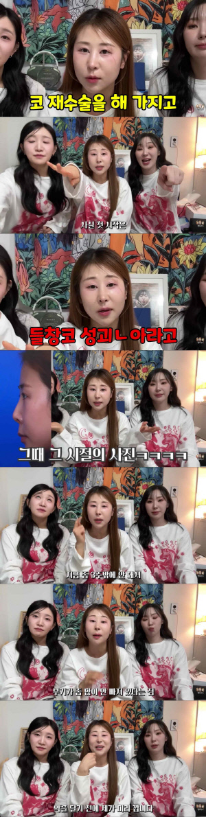 박세미, 코 재수술 후 확 바뀐 비주얼 