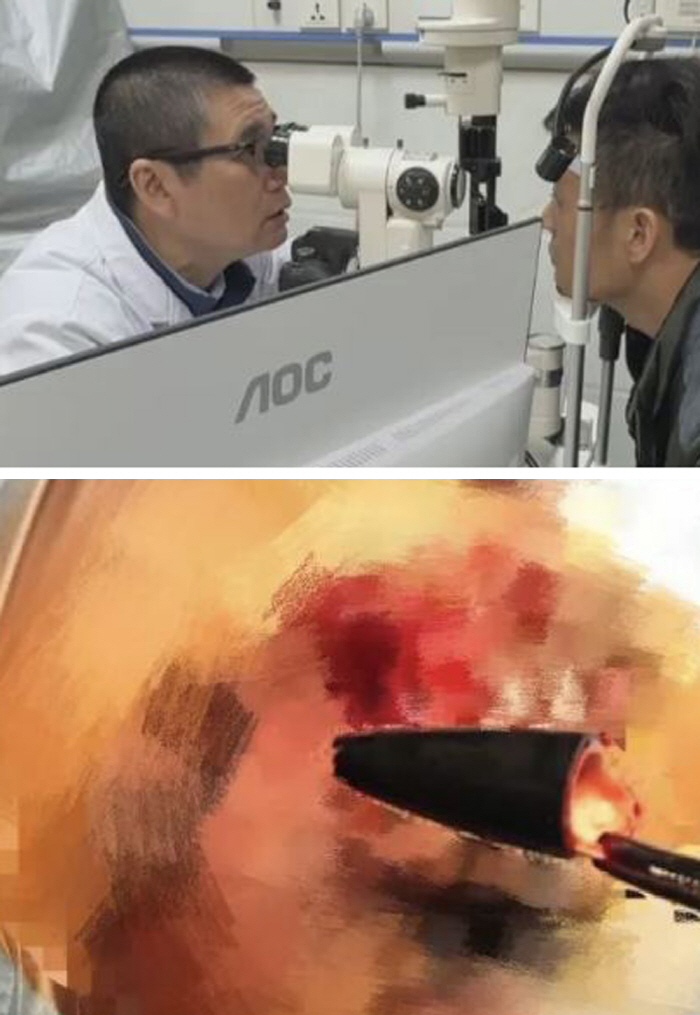 27년 전 눈에 박힌 2.5cm 볼펜 끝…"상상도 못했다"