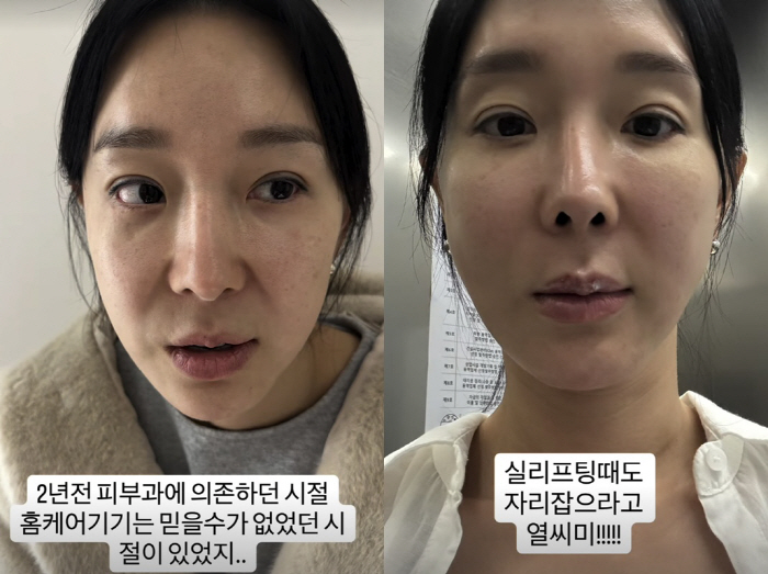 '46세' 이지혜, 적나라한 '인중축소술' 직후..입 못 다문 채 '냉찜…