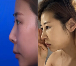 '서준맘' 박세미, 코 재수술 후회하나..