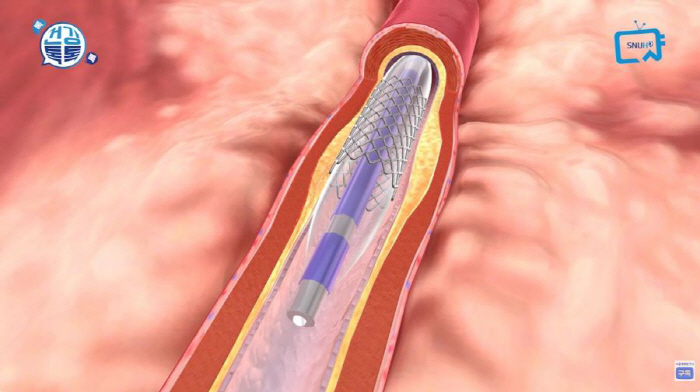 [심근경색 Q&A] 증상 의심 시 대처법은?…스텐트는 시간 지나면 교체?