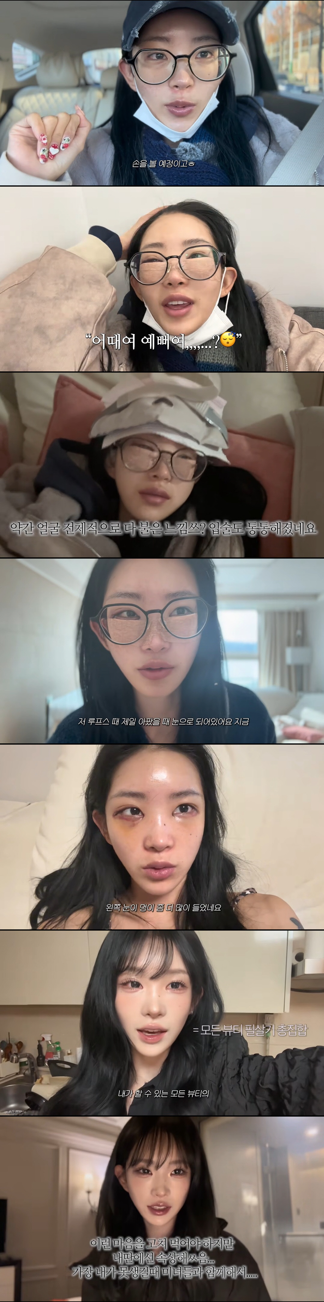 최준희, 눈 수술로 퉁퉁 부은 눈…속상한 심경 "예쁜 사람 많아 자존감 …