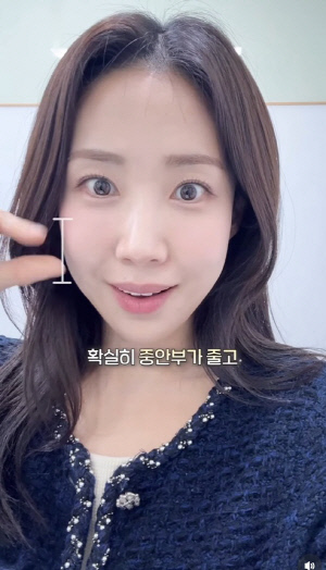 '여구여신' 최희, 중안부 축소 시술로 '확 달라진 얼굴'..