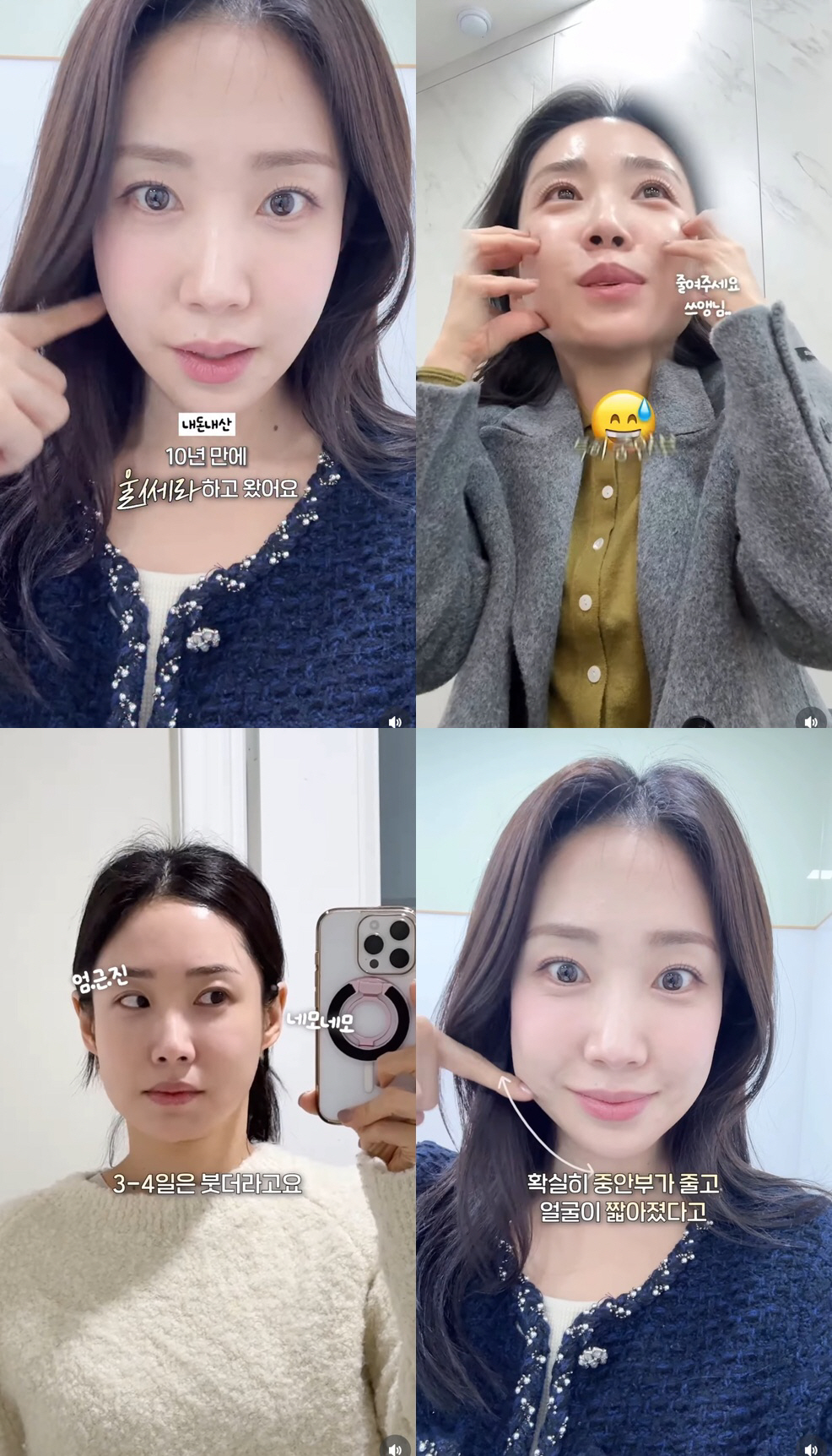 '여구여신' 최희, 중안부 축소 시술로 '확 달라진 얼굴'.."효과 대박…