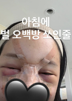 랄랄, 설연휴엔 '눈밑지방 재배치' 성형…