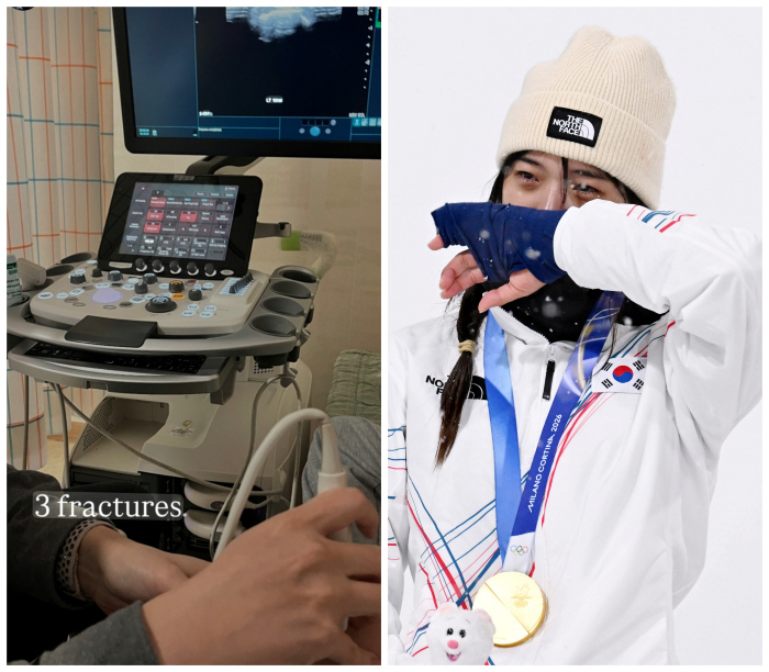 "얼마나 아팠을까" '불굴의 투혼 金' 최가온, 결국 세 군데 골절 진단