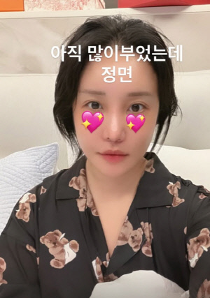 랄랄, 눈알 다 터졌다더니…피멍 딛고 미모 반전 