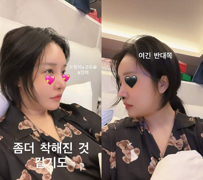 '73kg' 랄랄, 눈밑·코 성형 6일차..'확 달라진 얼굴' 인상까지 …