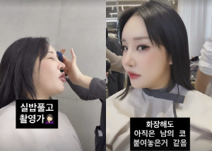 랄랄, '코 재수술' 부기 빠졌는데도 어색 