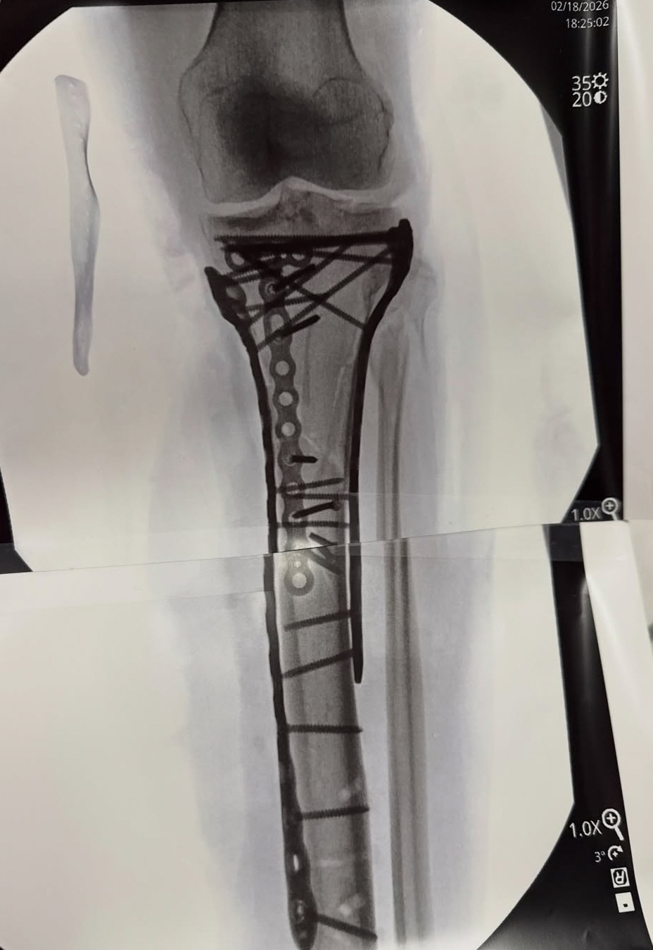 "다리 절단할 뻔, 죽다 살아났다" 5차례 대수술→2주 만의 퇴원! 직접…