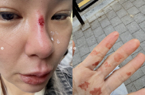 '정성호♥' 경맑음, 아스팔트에 얼굴 쓸려 피 철철…