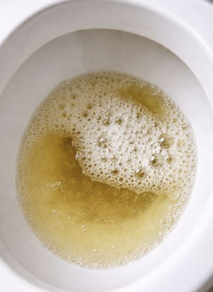 얼굴 붓고 끈적한 소변 거품, '단백뇨' 의심…원인 2가지