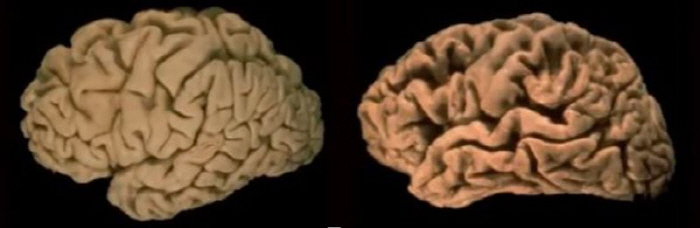 [알츠하이머병 Q&A] 방금 들은 말 잊고 같은 질문 반복…'4가지' 생…