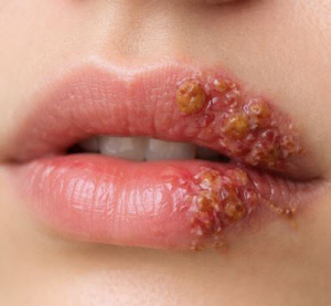 단순 입술 물집인 줄 알았는데, 30대 여성 뇌사 '충격'