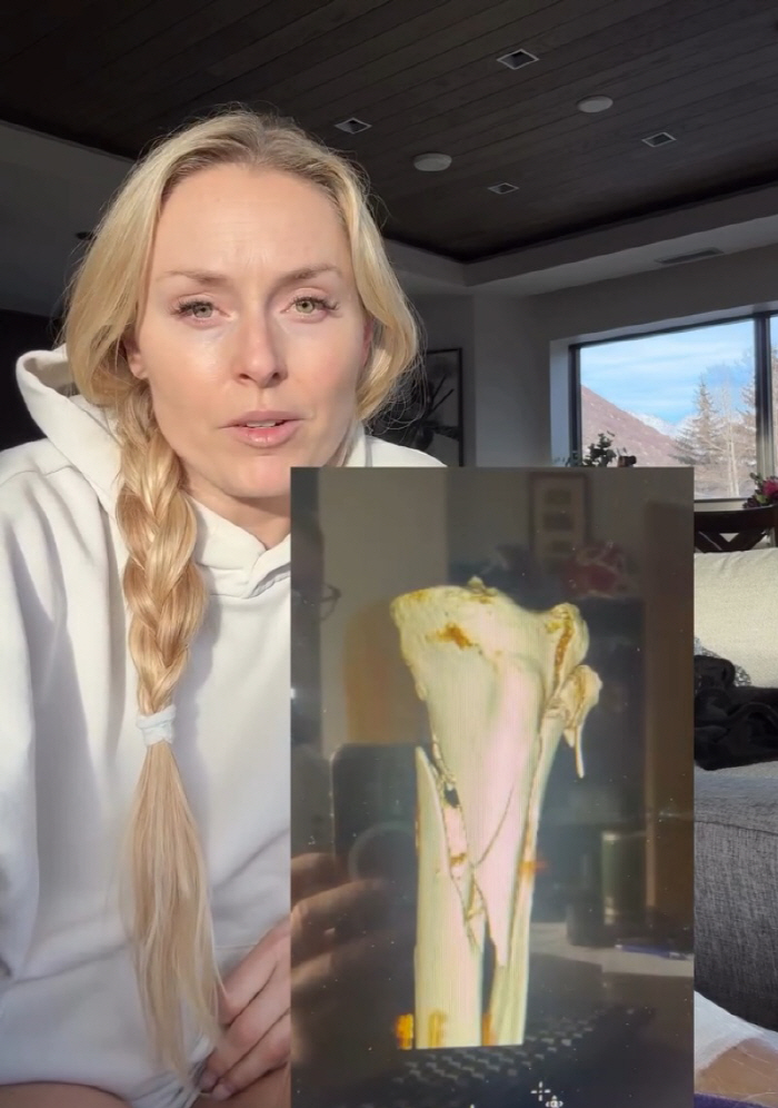 "너무나 힘든 현실" 다리 절단 피한 '스키 여제' 린지 본, 휠체어 타…