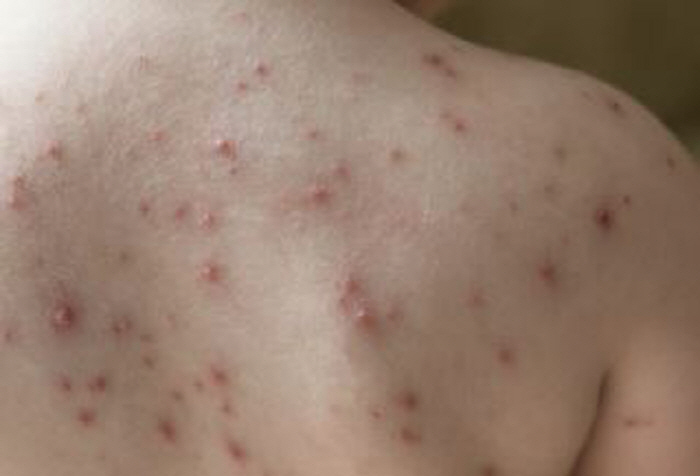 감기인 줄 알았는데…새 학기 급성 감염 '수두' 유행 주의