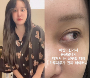 랄랄, 풍선 불다 눈 실핏줄 터졌다…