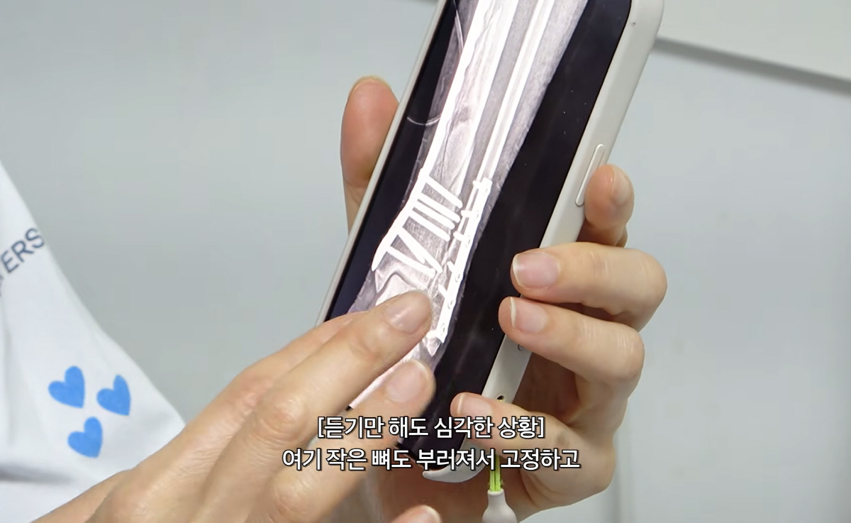 "발목 뼈가 완전 산산조각 나"…엄지원, 日여행중 돌발 사고→韓긴급후송 …