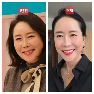 '64세' 윤영미, 10kg 감량→안면거상 후 확 달라진 얼굴 만족 