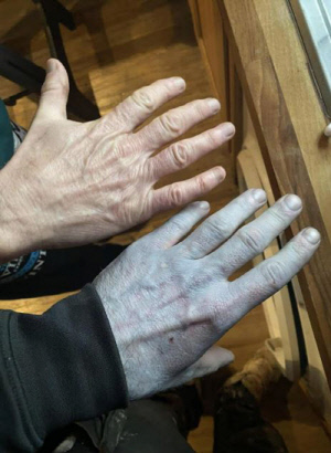 파란색으로 변한 손·얼굴, 긴급 이송…의료진 웃은 이유는?