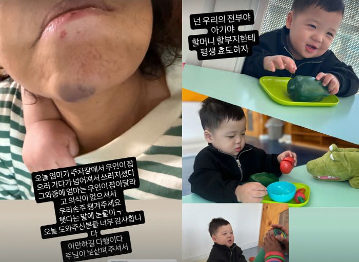 황보라母, 사고로 시퍼런 턱멍에도 손자 걱정...눈물 흘리며 "첫 낮잠 …