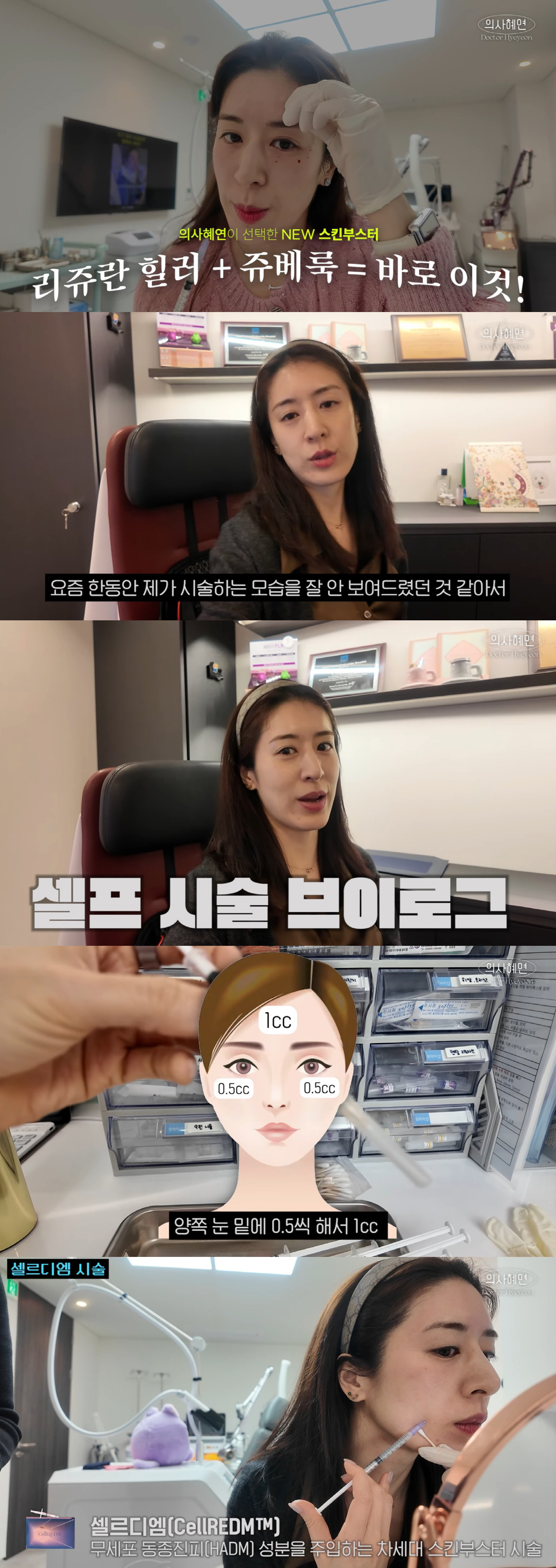 '주진모♥' 민혜연, '셀프 얼굴 시술'에 충격...푸른멍 '시술 직후 …