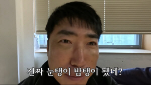 장동민, 시퍼렇게 멍든 눈에 깜짝 