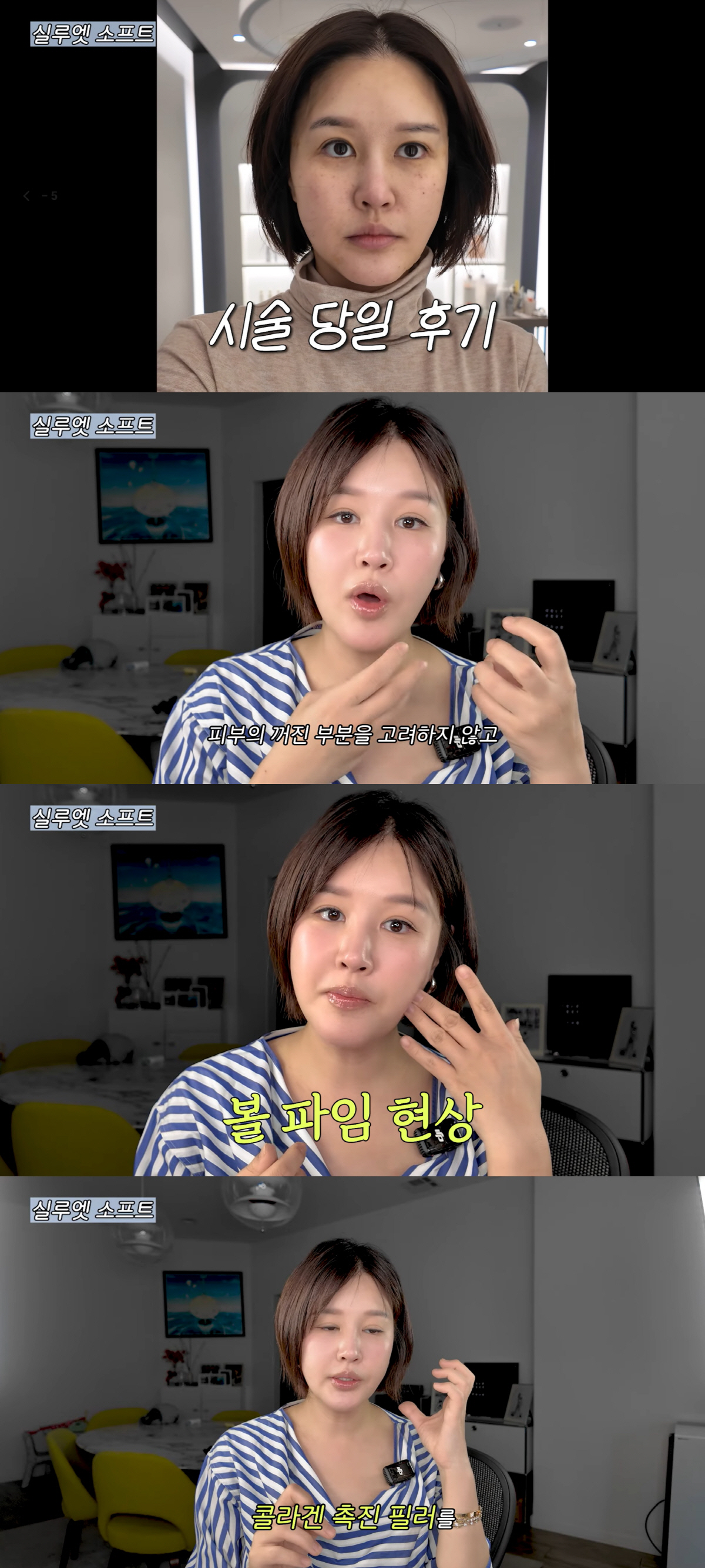 '43세' 박은지, 실리프팅 후 볼 패였다 "피부 고려 안하고 냅다 잡아…