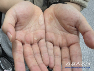 메달의 기적은 그냥 오지 않는다...하루 60km 김윤지의 '물집투성이' 손[밀라노-코르티나 패럴림픽]