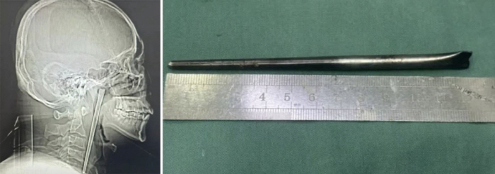 8년간 목에 12cm 젓가락 꽂힌 남성, 어쩌다가?