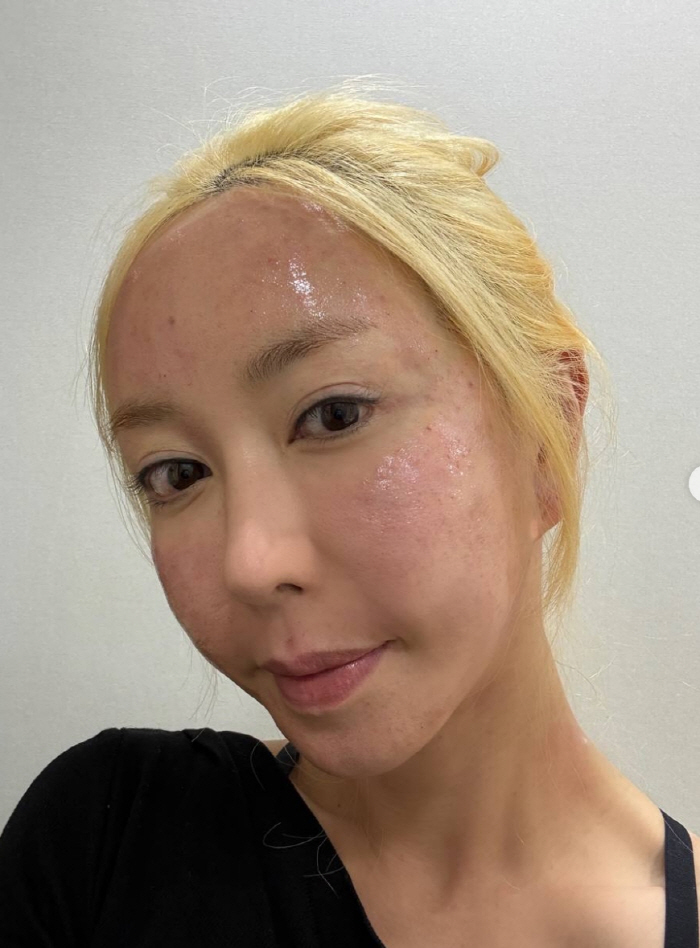 S.E.S 슈, 피부과 시술 직후 충격적인 얼굴 상태...12시간만에 변…