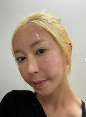 S.E.S 슈, 피부과 시술 직후 충격적인 얼굴 상태...12시간만에 변화 '깜짝'