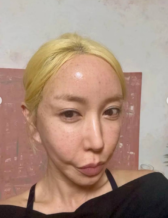S.E.S 슈, 피부과 시술 직후 충격적인 얼굴 상태...12시간만에 변화 '깜짝'