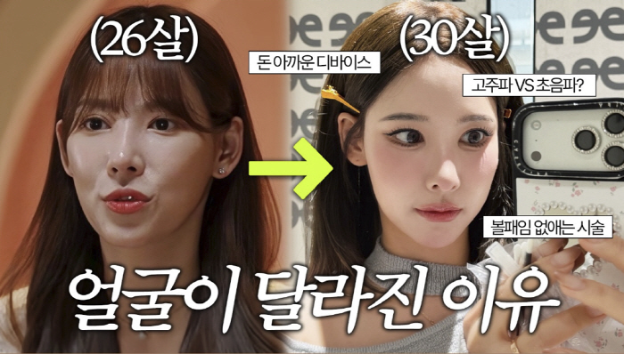 '환연2' 이나연, 확 달라지 얼굴...성형 아닌 시술 효과