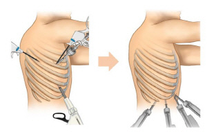 '늑간 보존 로봇 폐암 수술법' 안전성·효과성 입증…숨은 림프절 전이까지 발견