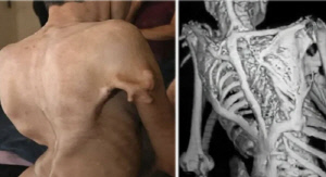 '몸이 돌처럼 굳는' 희귀질환 9세 소년…치료법 없고 통증 완화만