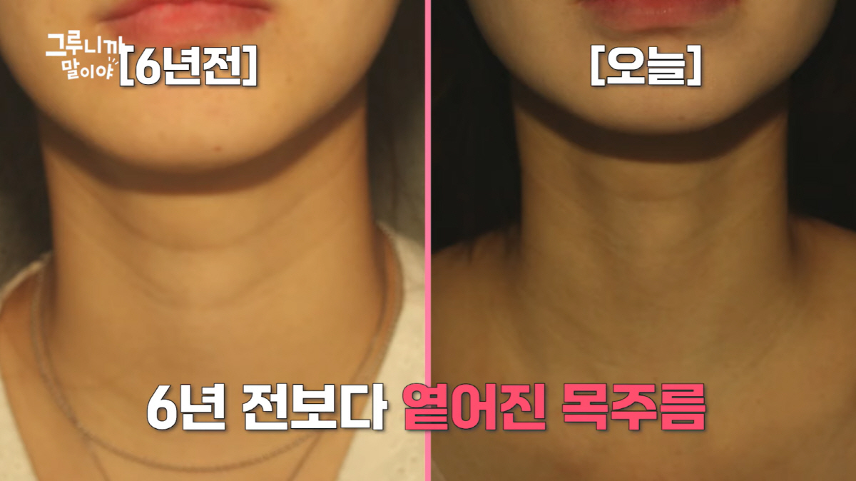 '싱글맘' 한그루, '목주름 시술' 후 확 달라졌다 "효과 너무 좋아"
